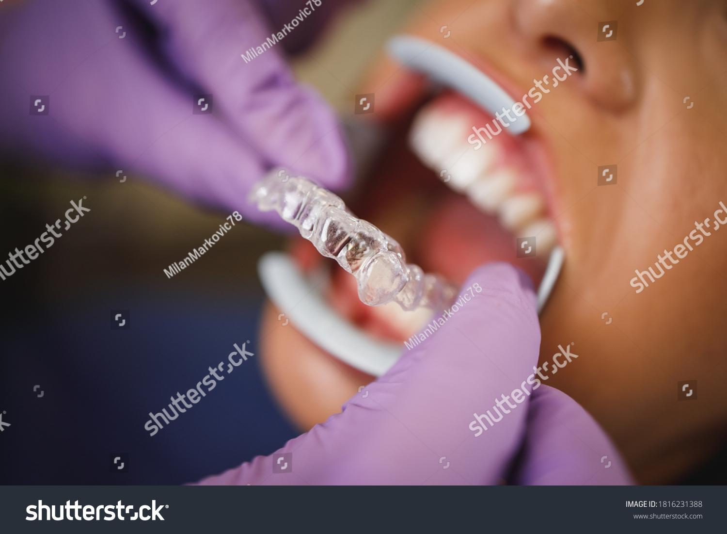 OrthoAligner ile Sürekli Hareket